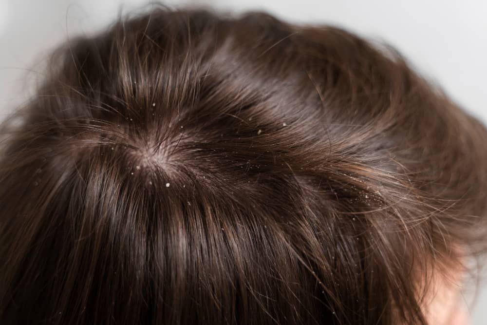 Effective Ways to Get Rid of Dandruff Naturally